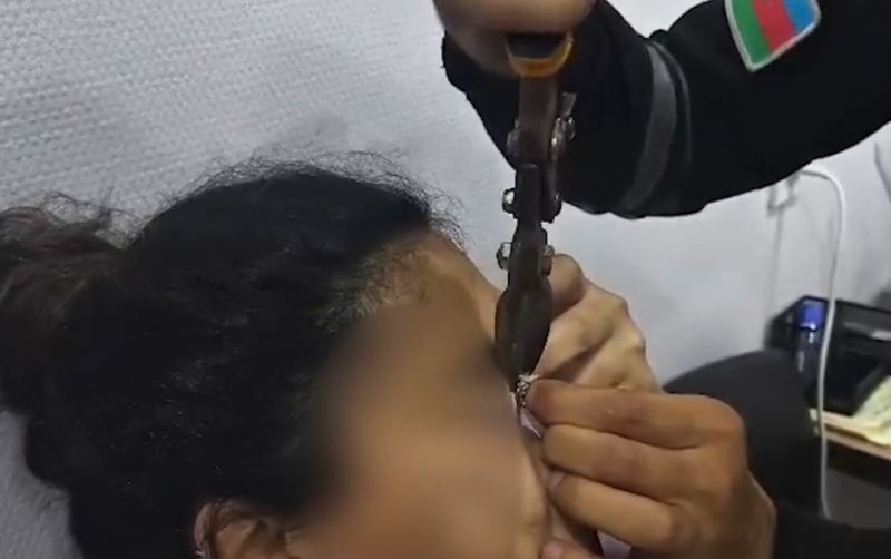 Göz qapağına geyiminin zəncirbəndi ilişdi  