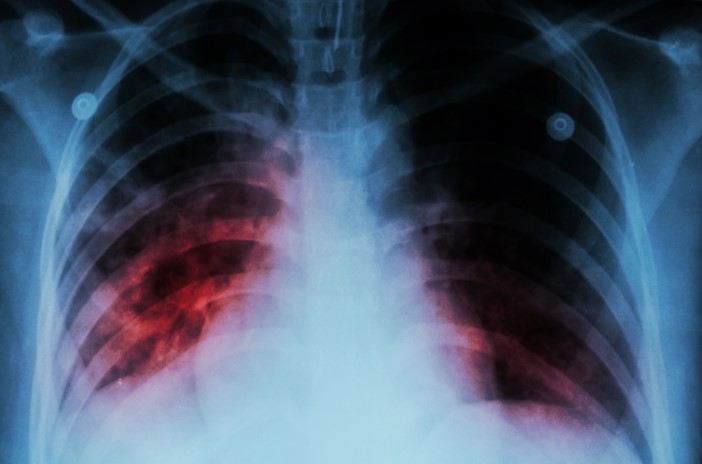 Ötən il 198 uşaq və yeniyetmə vərəmə yoluxub 